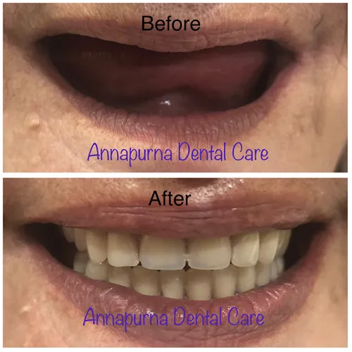 BPS Precision Dentures Case 17 - Annapurna Dental Care