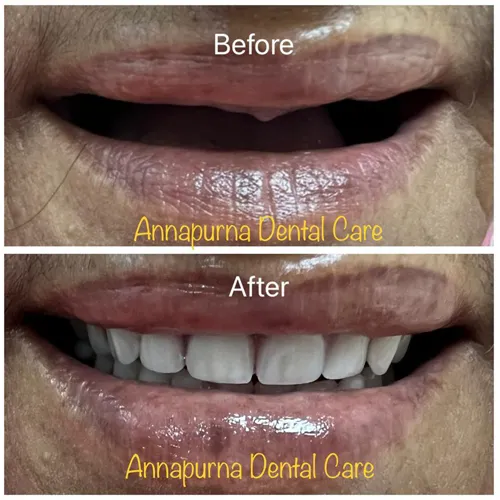 BPS Precision Prosthetic Dentures Case 33 - Annapurna Dental Care