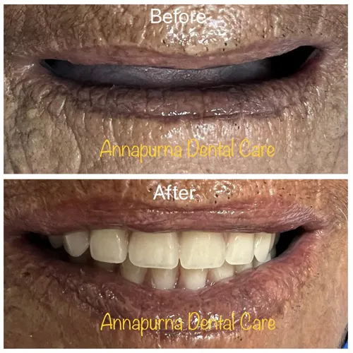 BPS High Aesthetic Dentures Case 34 - Annapurna Dental Care