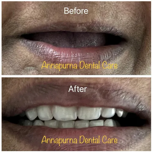 BPS Denture Fit and Function Case 35 - Annapurna Dental Care