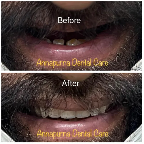 BPS Dentures Tooth Replacement Case 36 - Annapurna Dental Care