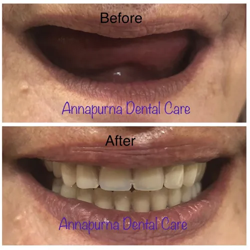 BPS Complete Denture Prosthetics Case 37 - Annapurna Dental Care