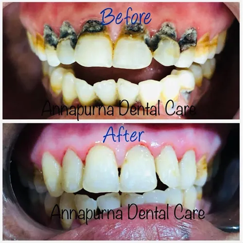 Cervical Tooth Restoration with Composite Case 27 - Annapurna Dental Care