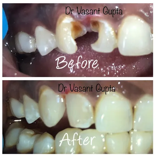 Class IV Composite Tooth Build Up Case 7 - Annapurna Dental Care