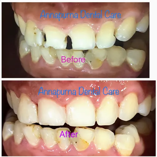 Composite Build Up Restoration Case 11 - Annapurna Dental Care