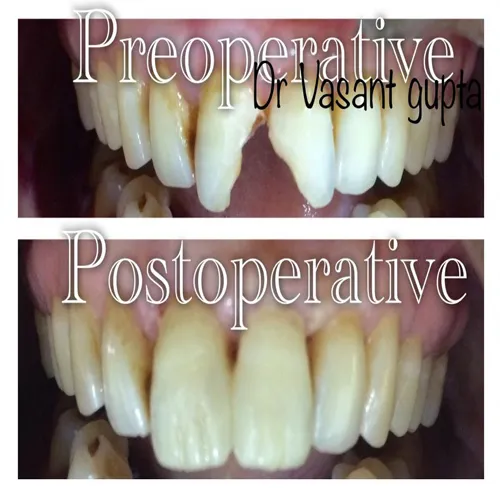 Composite Build Up Smile Restoration Case 38 - Annapurna Dental Care