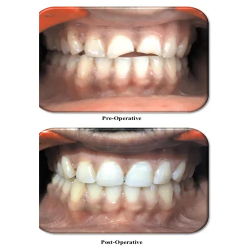 Composite Tooth Build Up Case 39 - Annapurna Dental Care