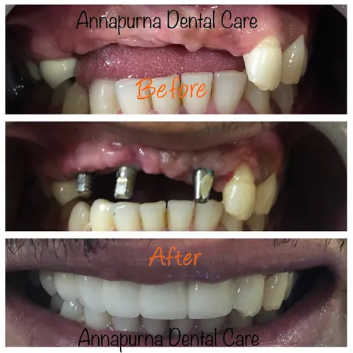 Dental Implants Surgery Case 9 - Annapurna Dental Care