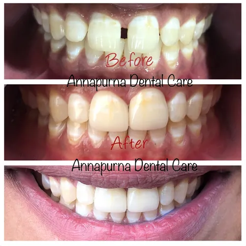 Diastema Midline Space Closure with Veneers Case 26 - Annapurna Dental Care
