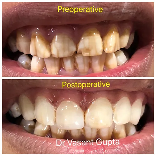 Direct Composite Veneers Case 1 - Annapurna Dental Care