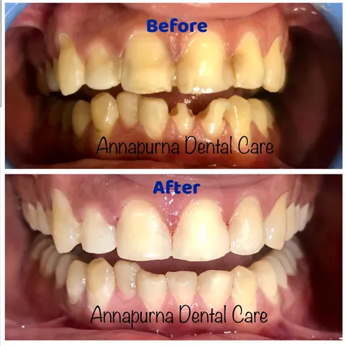 Direct Composite Veneers Case 15 - Annapurna Dental Care