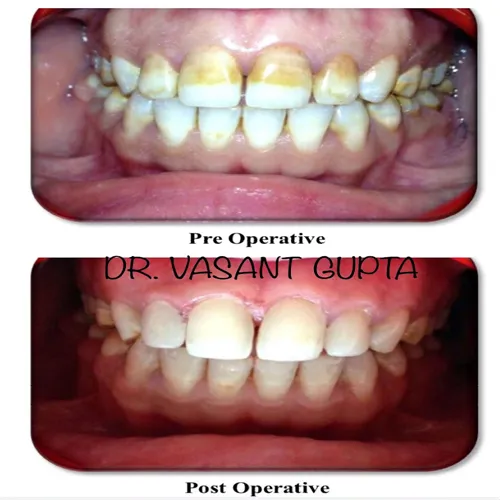 Direct Composite Veneers Smile Case 28 - Annapurna Dental Care