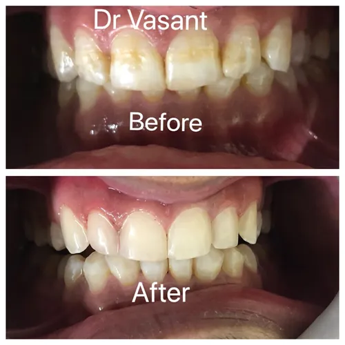 Direct Composite Veneers Case 4 - Annapurna Dental Care
