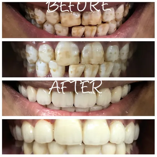 Fluorosis Treatment with Indirect Veneers Case 29 - Annapurna Dental Care