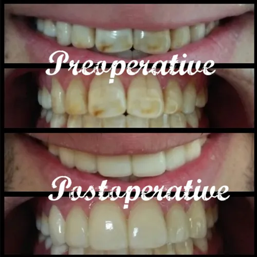 Fluorosis Treatment with Indirect Veneers Case 30 - Annapurna Dental Care
