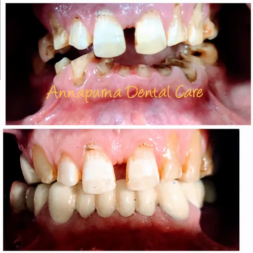 Full Mouth Dental Rehabilitation Case 10 - Annapurna Dental Care