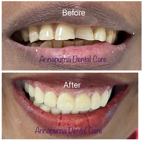 Full Mouth Rehabilitation with Cercon Crowns Case 19 - Annapurna Dental Care
