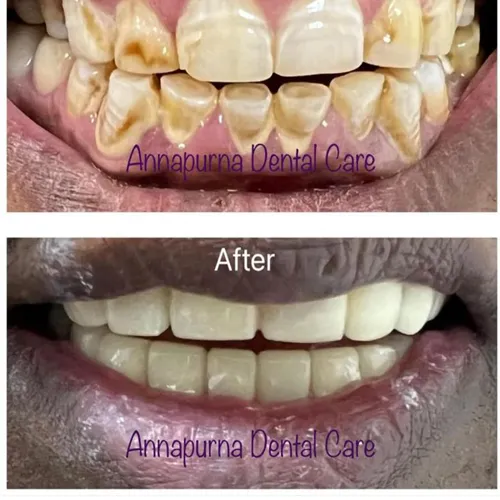 Full Mouth Rehabilitation with Zirconia Crowns Case 22 - Annapurna Dental Care