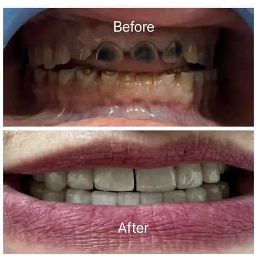 Full Mouth Rehabilitation Zirconia Crowns Case 40 - Annapurna Dental Care