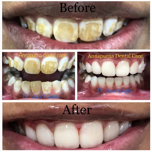 Indirect Veneers Cosmetic Makeover Case 14 - Annapurna Dental Care