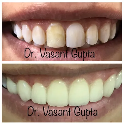 Indirect Veneers Smile Transformation Case 2 - Annapurna Dental Care