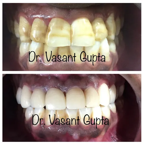 Indirect Porcelain Veneers Case 3 - Annapurna Dental Care