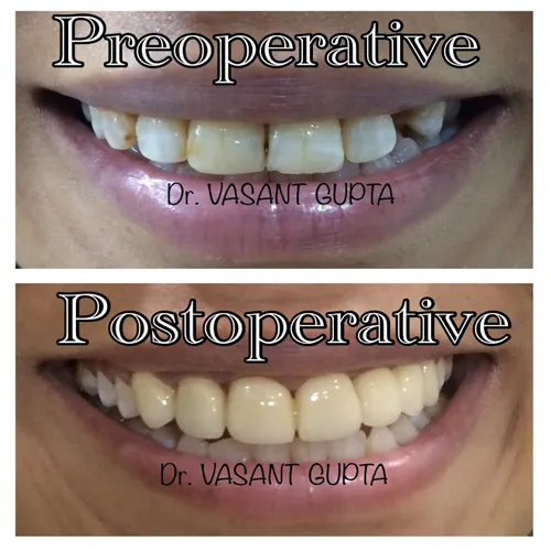 Indirect Veneers Smile Restoration Case 6 - Annapurna Dental Care