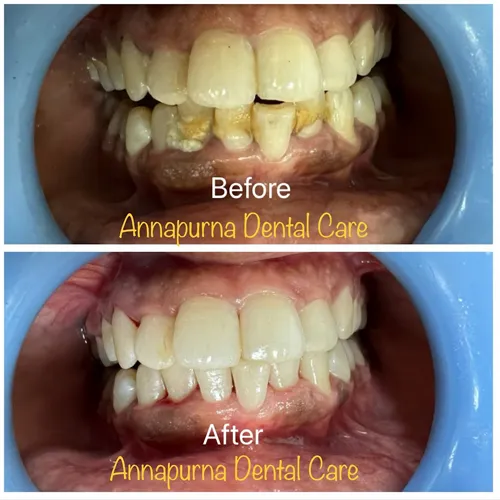 Laser Scaling and Polishing Case 24 - Annapurna Dental Care