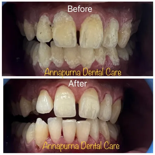 Laser Periodontal Scaling Case 41 - Annapurna Dental Care
