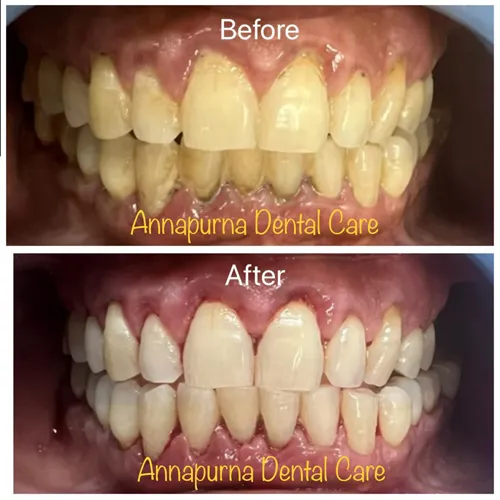 Laser Deep Scaling and Root Planing Case 42 - Annapurna Dental Care