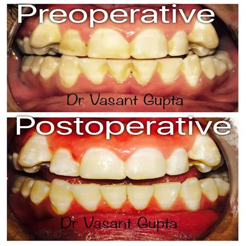 Laser Scaling Periodontal Cleaning Case 5 - Annapurna Dental Care