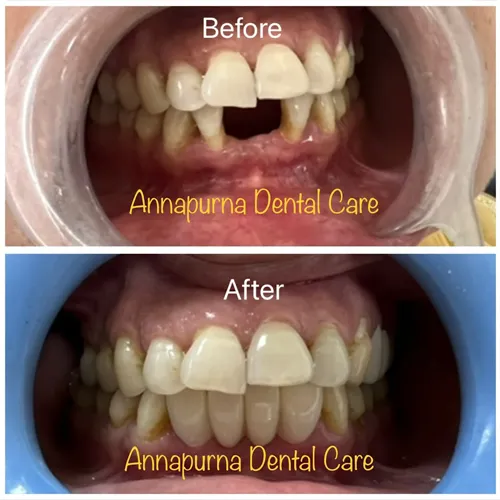Missing Teeth Replaced with Zirconia Crowns Case 23 - Annapurna Dental Care