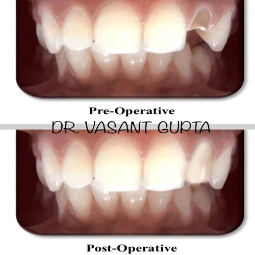 Post and Core Tooth Restoration Case 8 - Annapurna Dental Care