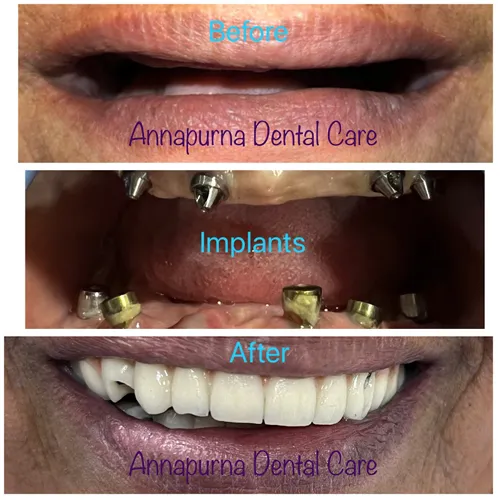 Full Mouth Implants Rehabilitation Case 20 - Annapurna Dental Care