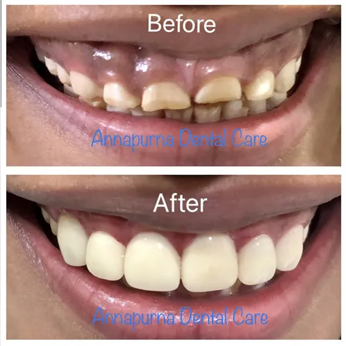Aesthetic Smile Designing Transformation Case 16 - Annapurna Dental Care
