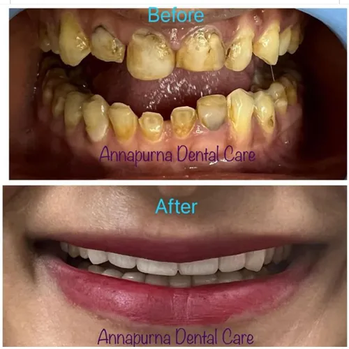 Smile Designing with Zirconia Crowns Case 21 - Annapurna Dental Care