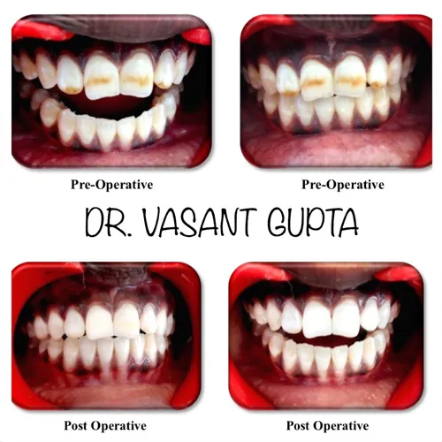 Professional Tooth Bleaching Whitening Case 25 - Annapurna Dental Care
