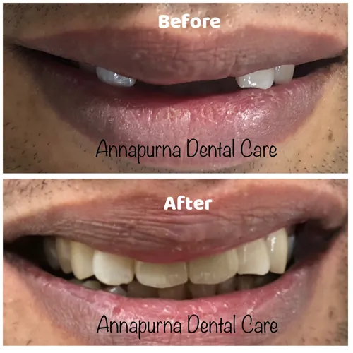 Zirconia Crown on Dental Implant Case 18 - Annapurna Dental Care