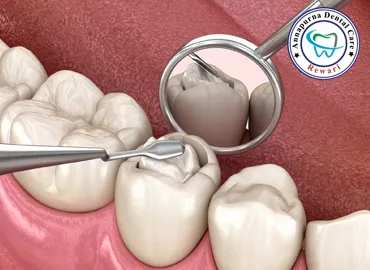 Tooth-Colored Composite Fillings and Pit-Fissure Sealants