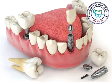 Permanent Dental Implants Surgery