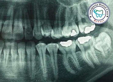 High Definition Digital Dental X-Rays RVG