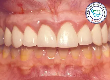 Periodontal Gum Disease and Pyorrhea Care