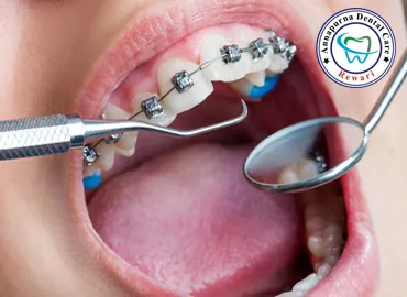 Orthodontic Ceramic Braces and Clear Invisible Aligners