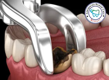 Painless Tooth and Wisdom Tooth Extraction