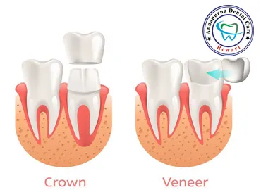 Custom Porcelain Veneers and CAD-CAM Zirconia Crowns