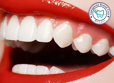 Laser Teeth Whitening and Enamel Bleaching